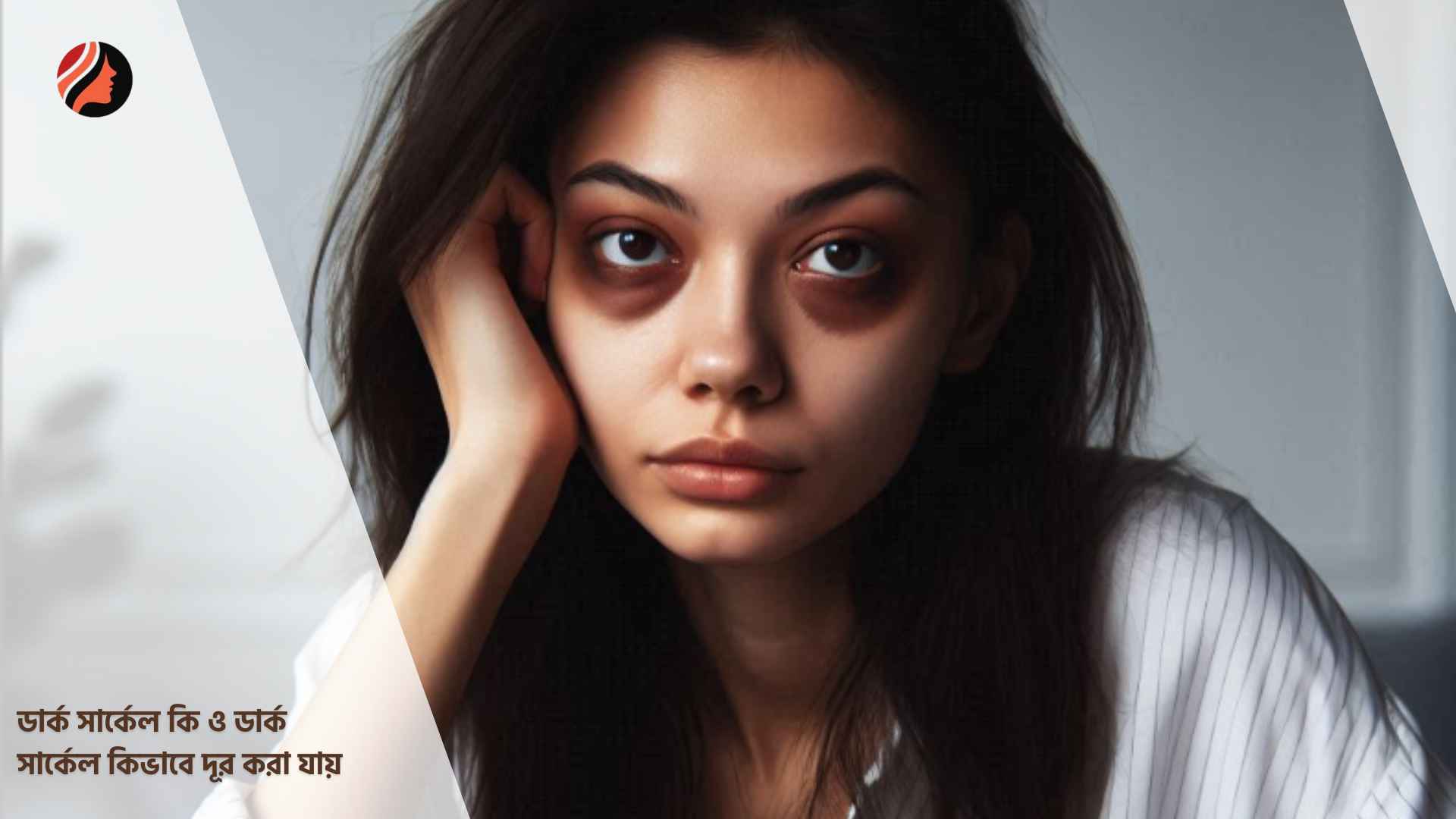 You are currently viewing ডার্ক সার্কেল কি ও ডার্ক সার্কেল কিভাবে দূর করা যায়