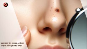 Read more about the article ব্ল্যাকহেডস কি, কেন হয় ও নাকের হোয়াইট হেডস দূর করার উপায়